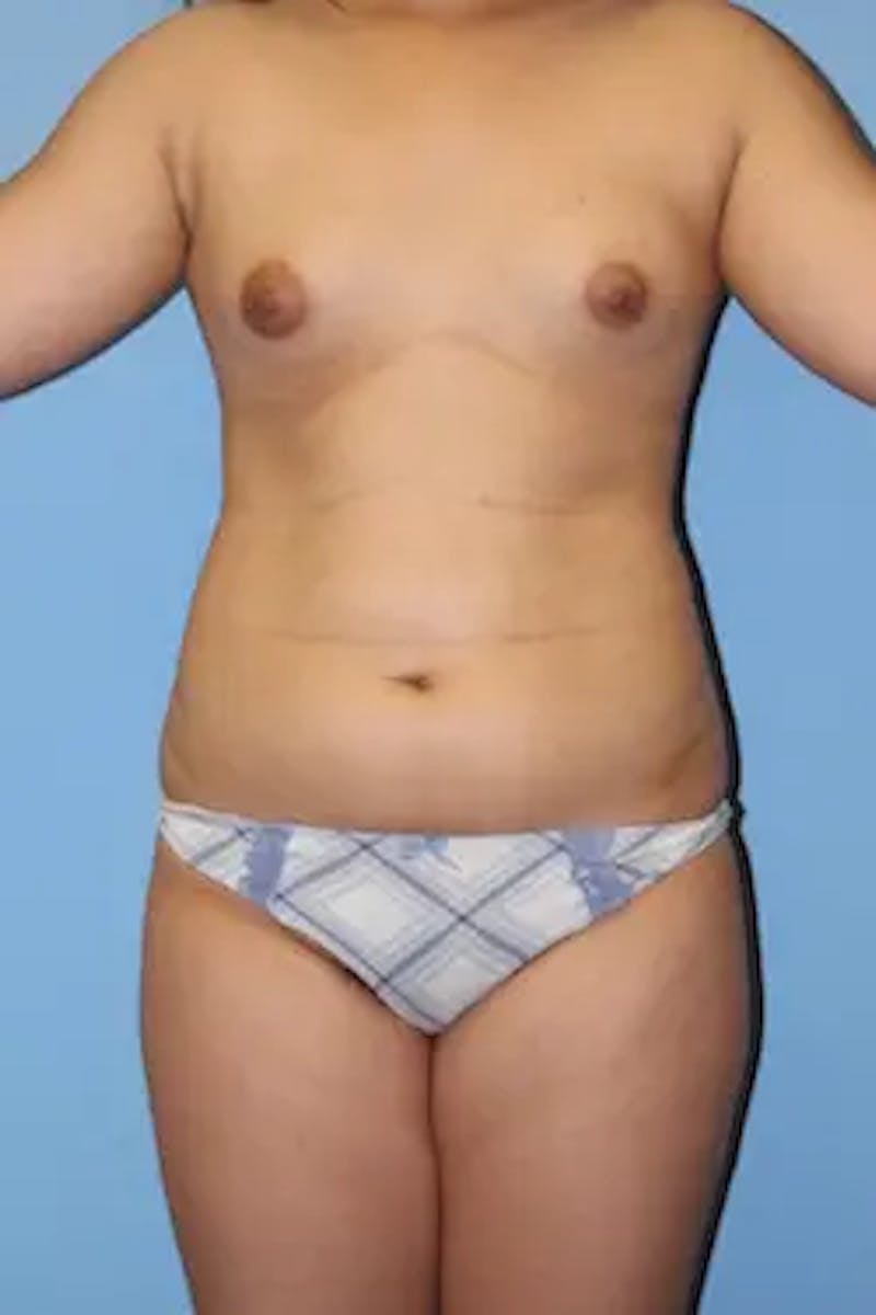 Liposuction Before & After Gallery - Patient 419456 - Image 1