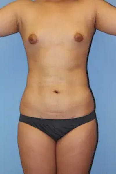 Liposuction Before & After Gallery - Patient 419456 - Image 2