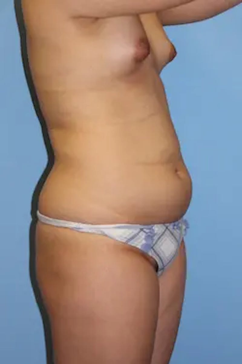 Liposuction Before & After Gallery - Patient 419456 - Image 3