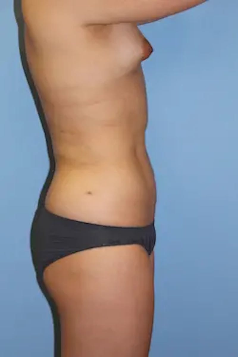 Liposuction Before & After Gallery - Patient 419456 - Image 6