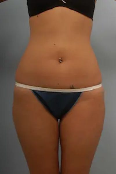 Liposuction Before & After Gallery - Patient 426680 - Image 2