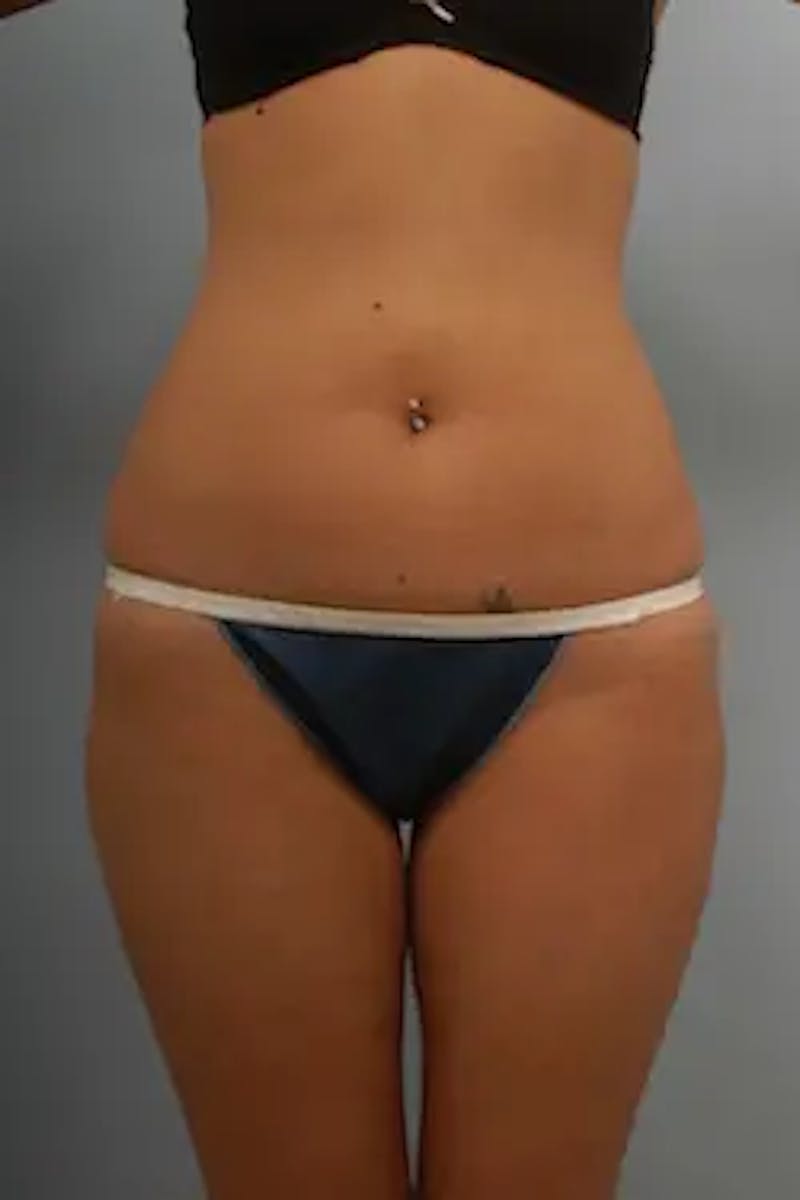 Liposuction Before & After Gallery - Patient 426680 - Image 2
