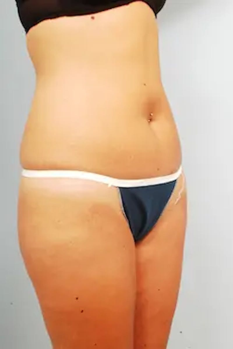 Liposuction Before & After Gallery - Patient 426680 - Image 3