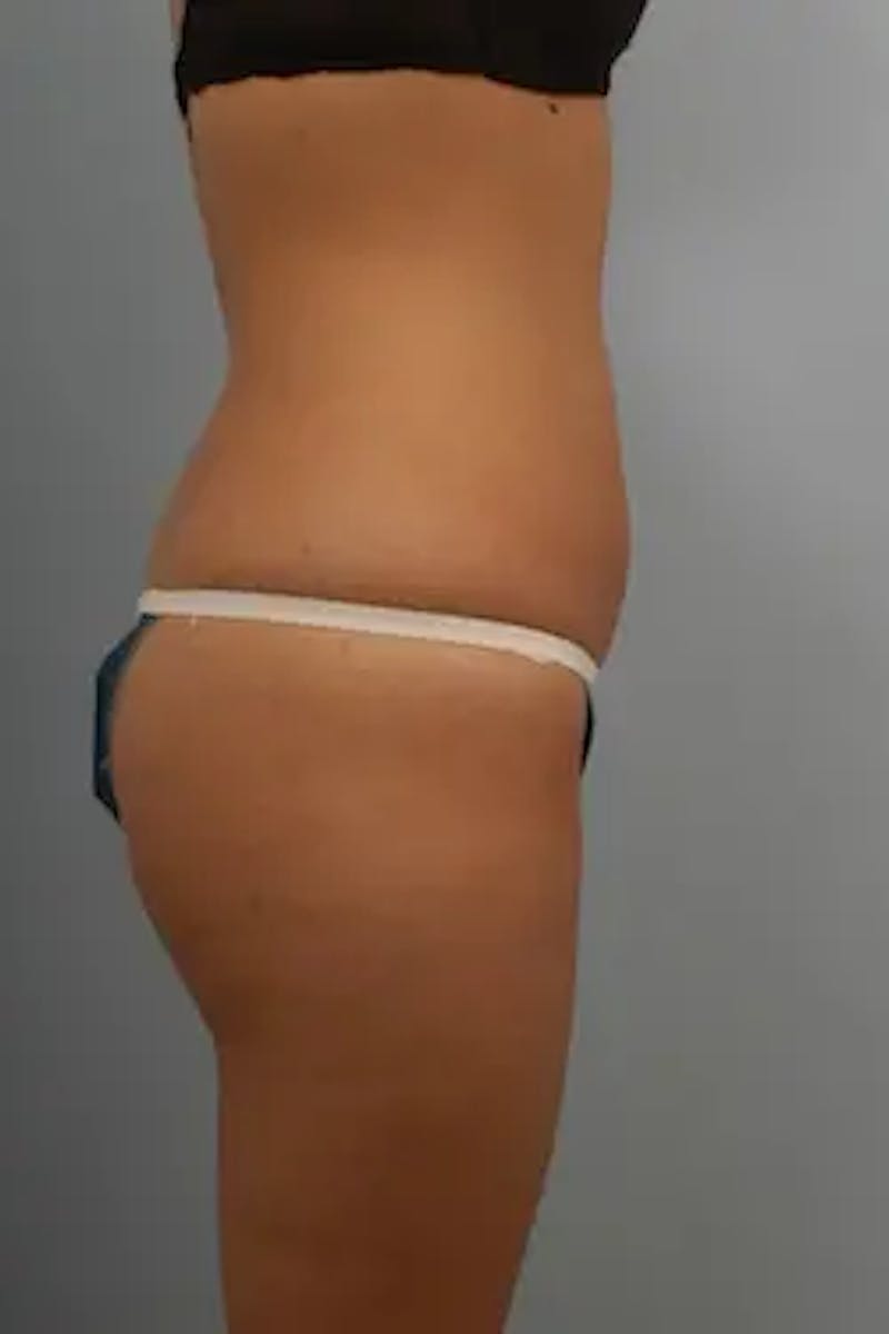 Liposuction Before & After Gallery - Patient 426680 - Image 6
