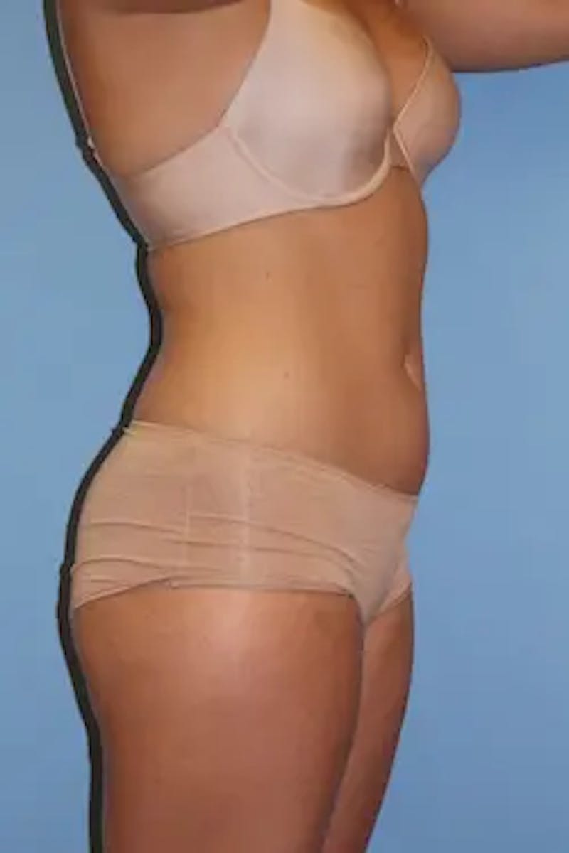 Liposuction Before & After Gallery - Patient 725968 - Image 3