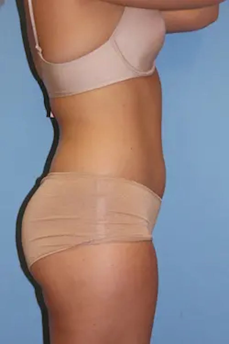 Liposuction Before & After Gallery - Patient 725968 - Image 5