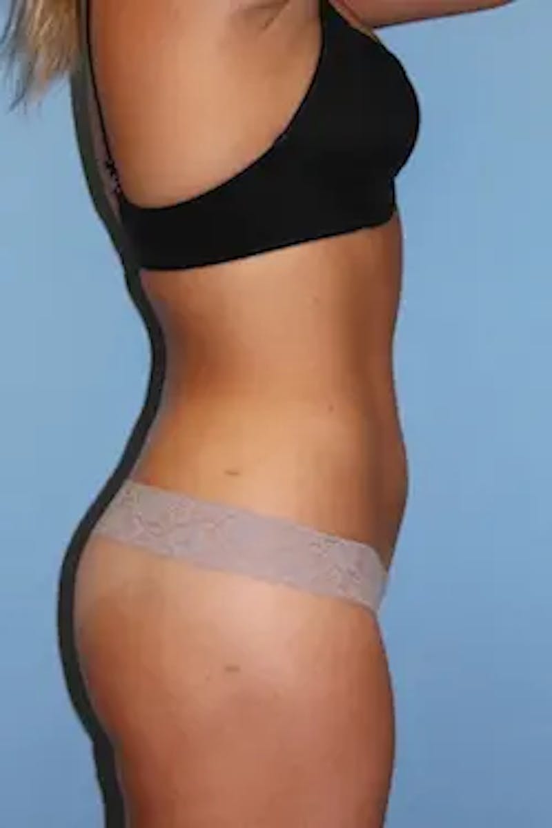 Liposuction Before & After Gallery - Patient 725968 - Image 6