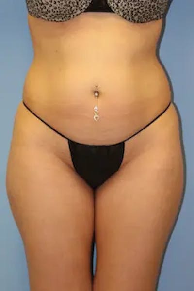 Liposuction Before & After Gallery - Patient 310848 - Image 1