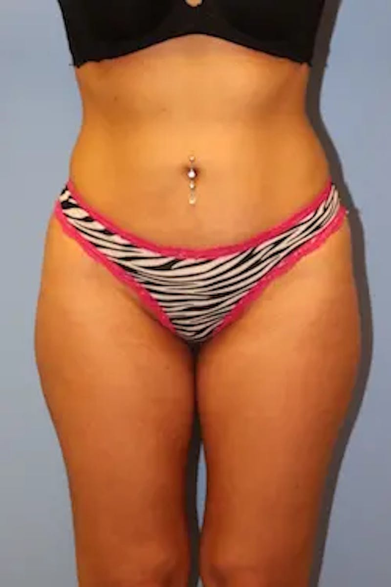 Liposuction Before & After Gallery - Patient 310848 - Image 2