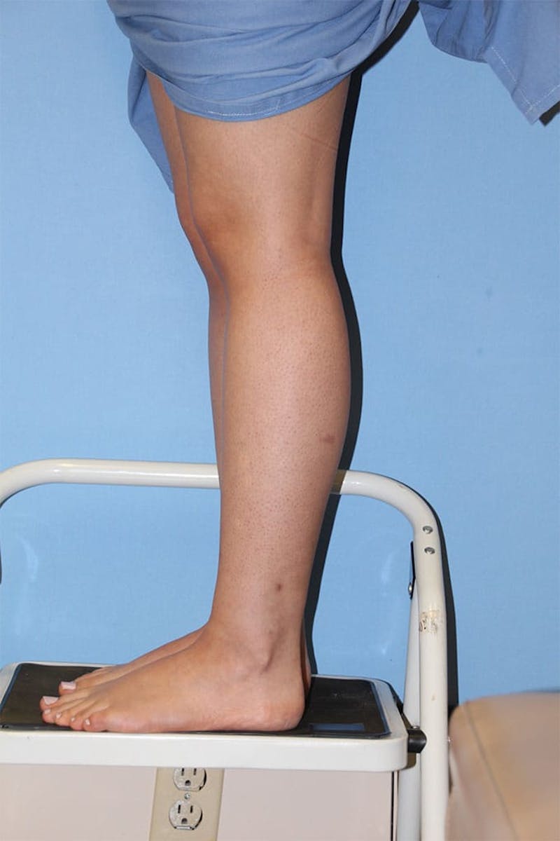 Ankle & Calf Liposuction Before & After Gallery - Patient 133216 - Image 4