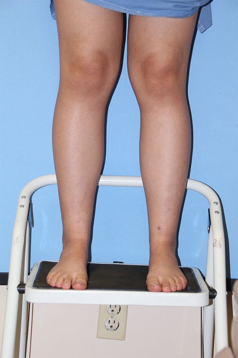 Ankle & Calf Liposuction Before & After Gallery - Patient 133216 - Image 2