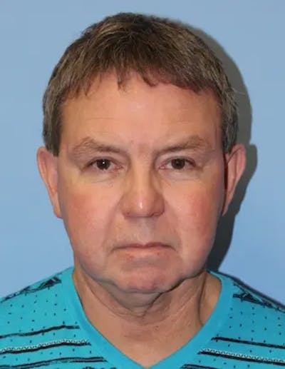 Chin Implants Before & After Gallery - Patient 231017 - Image 1