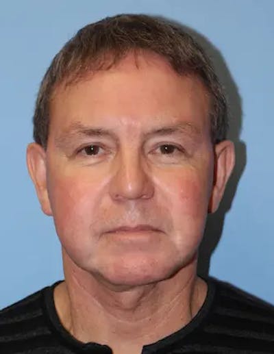 Chin Implants Before & After Gallery - Patient 231017 - Image 2