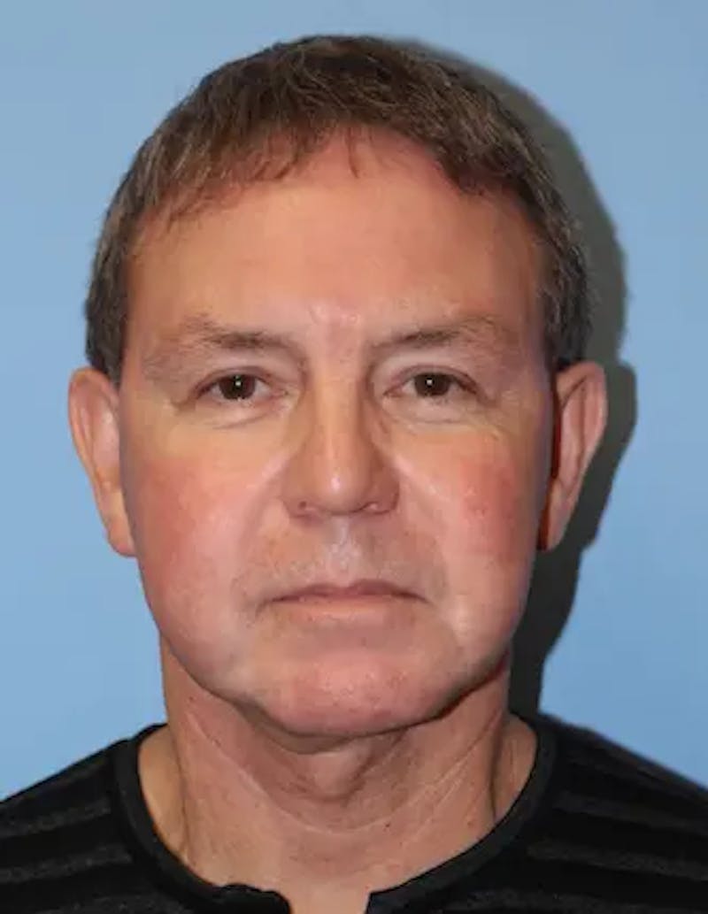 Chin Implants Before & After Gallery - Patient 231017 - Image 2
