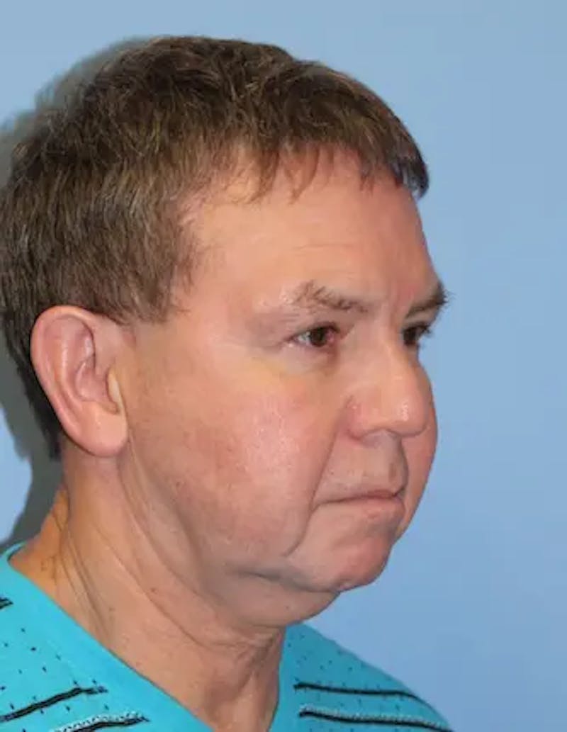 Chin Implants Before & After Gallery - Patient 231017 - Image 3