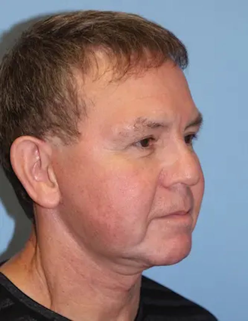 Chin Implants Before & After Gallery - Patient 231017 - Image 4