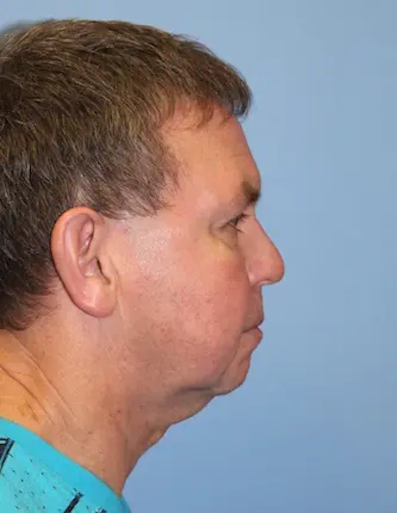 Chin Implants Before & After Gallery - Patient 231017 - Image 5
