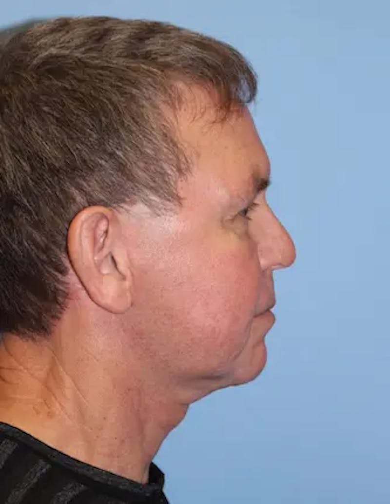Chin Implants Before & After Gallery - Patient 231017 - Image 6