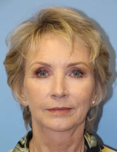 Chin Implants Before & After Gallery - Patient 281451 - Image 2