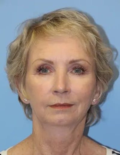 Chin Implants Before & After Gallery - Patient 281451 - Image 1