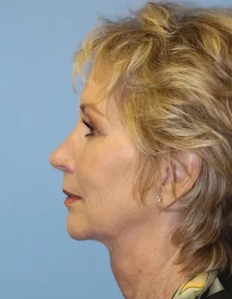Chin Implants Before & After Gallery - Patient 281451 - Image 4