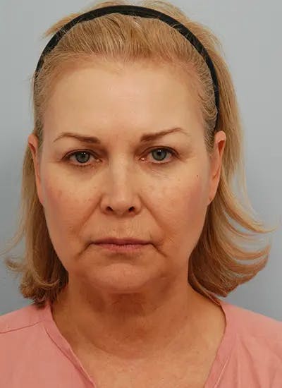 Facelift Before & After Gallery - Patient 461064 - Image 1