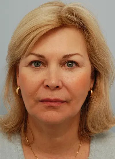 Facelift Before & After Gallery - Patient 461064 - Image 2