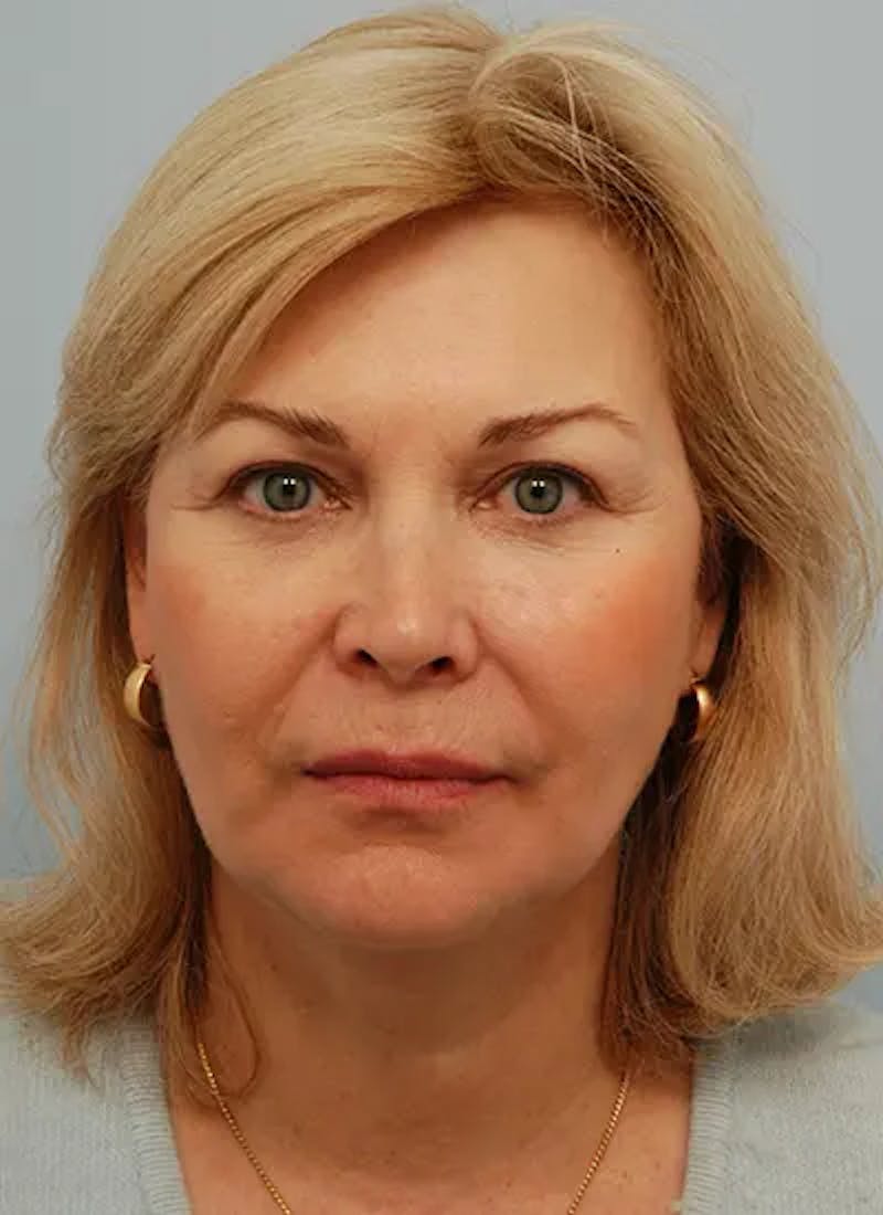 Facelift Before & After Gallery - Patient 461064 - Image 2