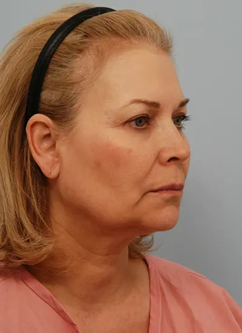 Facelift Before & After Gallery - Patient 461064 - Image 3