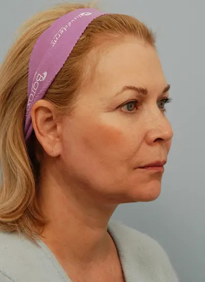 Facelift Before & After Gallery - Patient 461064 - Image 4
