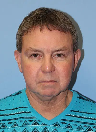 Facelift Before & After Gallery - Patient 292687 - Image 1