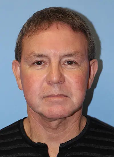 Facelift Before & After Gallery - Patient 292687 - Image 2