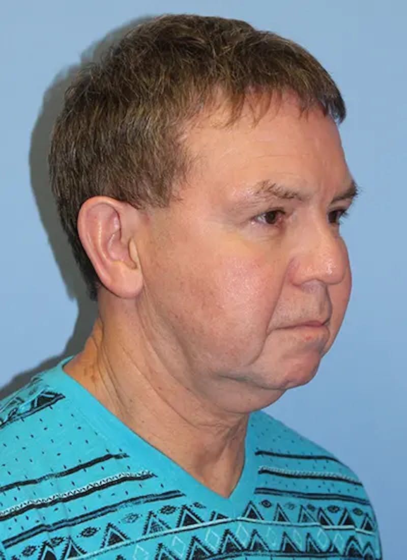 Facelift Before & After Gallery - Patient 292687 - Image 3
