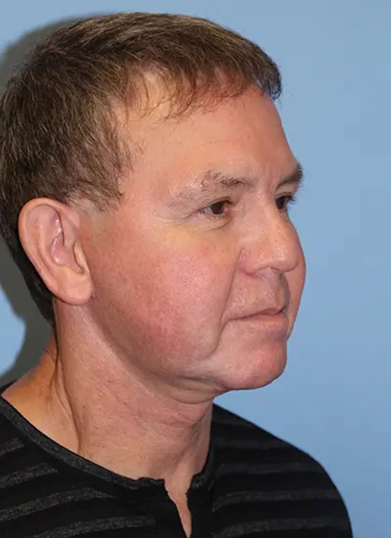 Facelift Before & After Gallery - Patient 292687 - Image 4