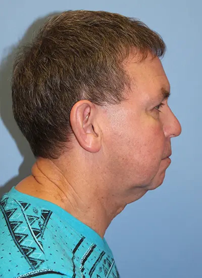 Facelift Before & After Gallery - Patient 292687 - Image 5