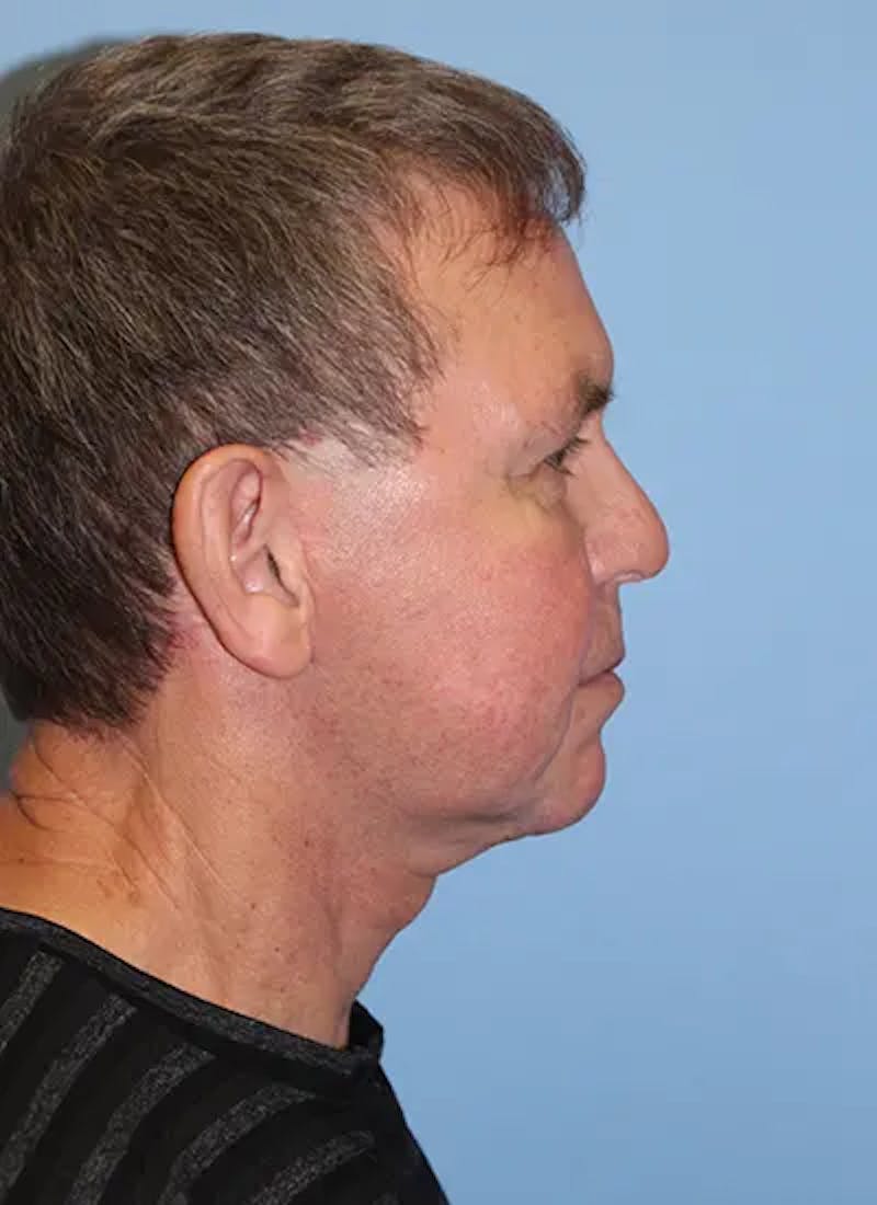 Facelift Before & After Gallery - Patient 292687 - Image 6