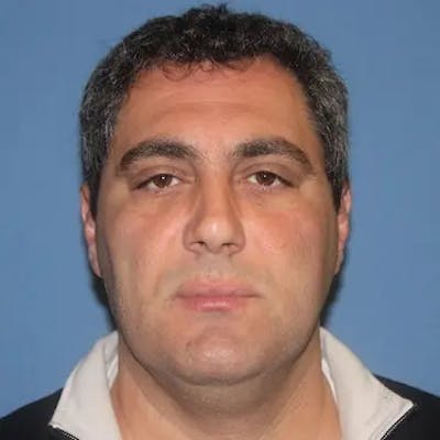 Facelift Before & After Gallery - Patient 152796 - Image 1