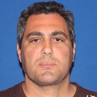 Facelift Before & After Gallery - Patient 152796 - Image 2