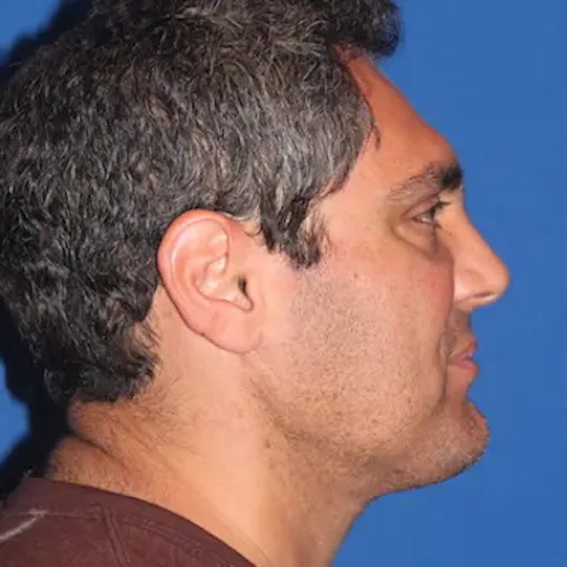 Male Facelift Before & After Gallery - Patient 222421 - Image 4