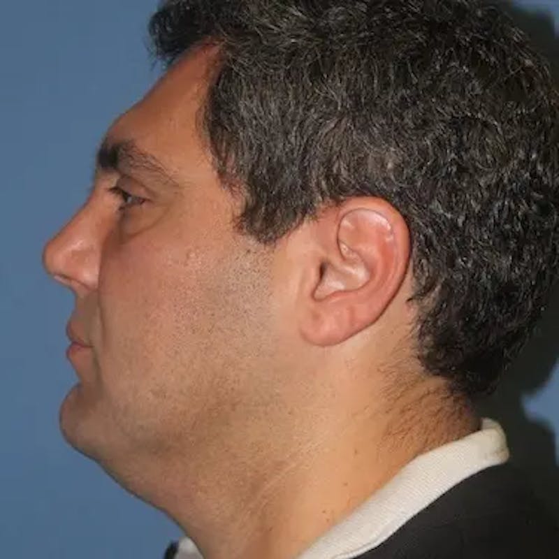 Male Facelift Before & After Gallery - Patient 222421 - Image 5