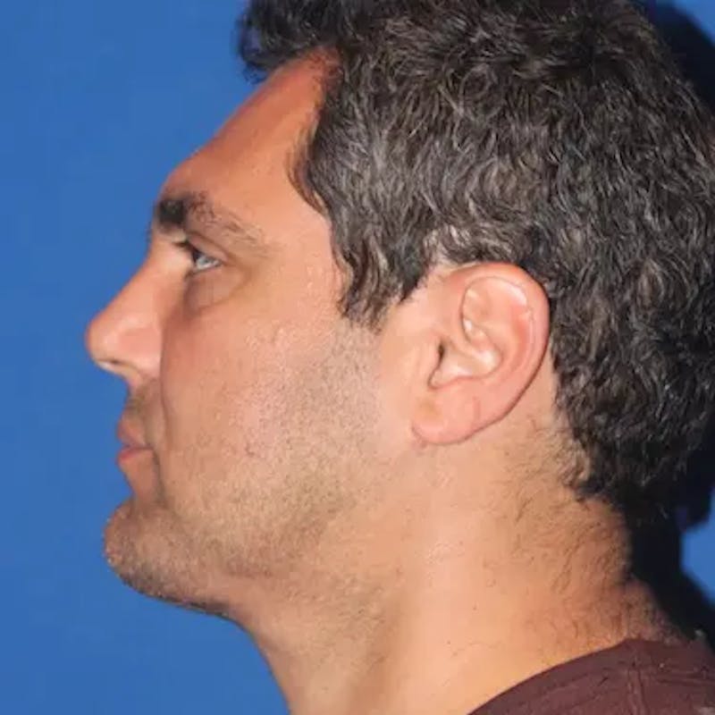 Male Facelift Before & After Gallery - Patient 222421 - Image 6