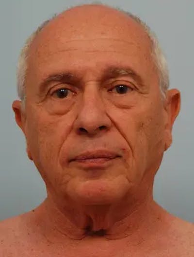 Facelift Before & After Gallery - Patient 218450 - Image 1