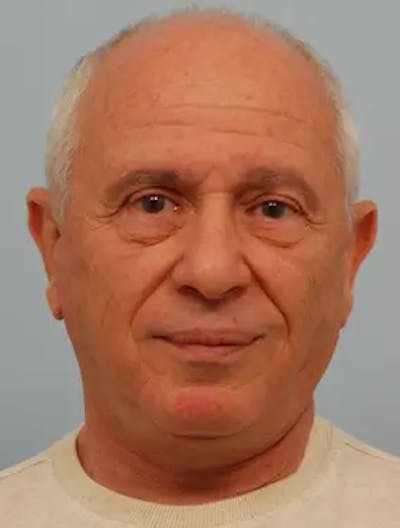 Facelift Before & After Gallery - Patient 218450 - Image 2