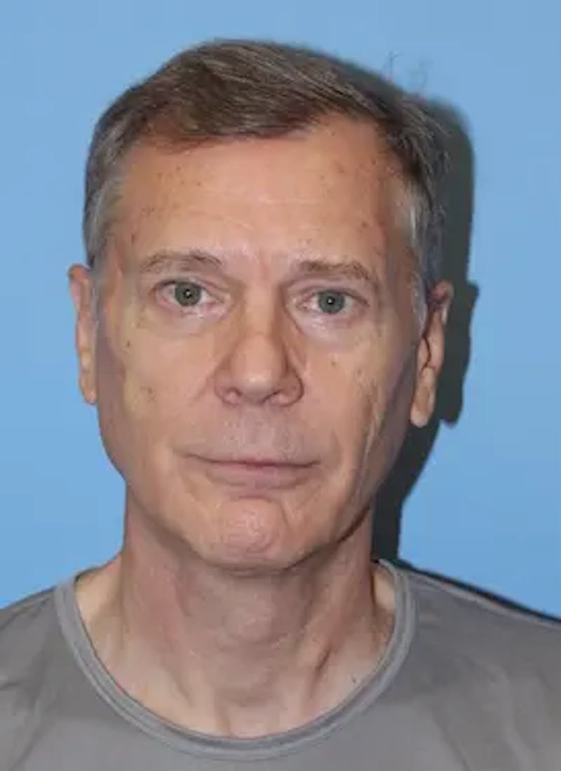 Male Facelift Before & After Gallery - Patient 178732 - Image 2