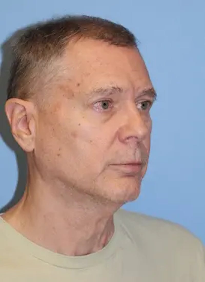Male Facelift Before & After Gallery - Patient 178732 - Image 3