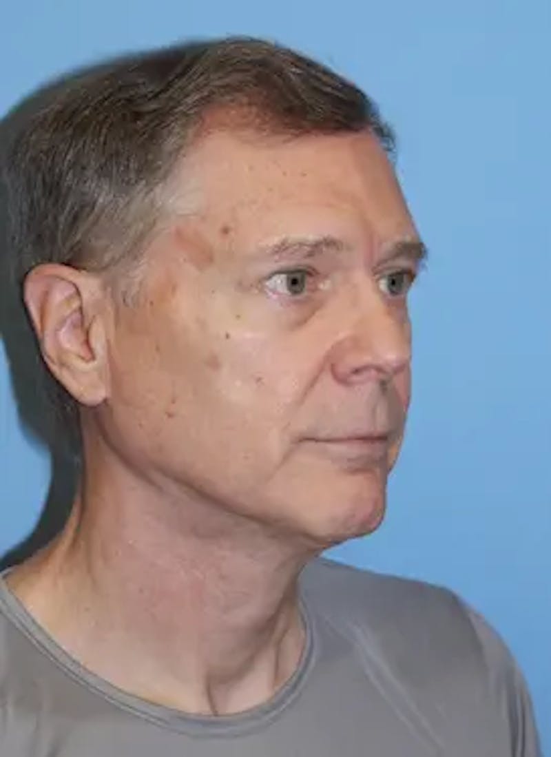 Male Facelift Before & After Gallery - Patient 178732 - Image 4