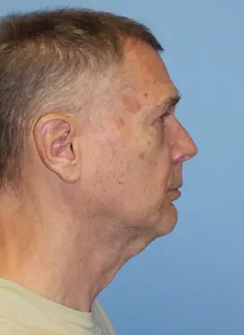 Male Facelift Before & After Gallery - Patient 178732 - Image 5