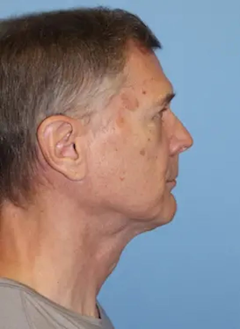 Male Facelift Before & After Gallery - Patient 178732 - Image 6