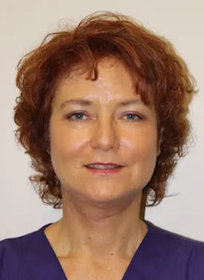 Facelift Before & After Gallery - Patient 302875 - Image 1