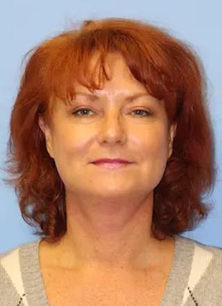 Facelift Before & After Gallery - Patient 302875 - Image 2